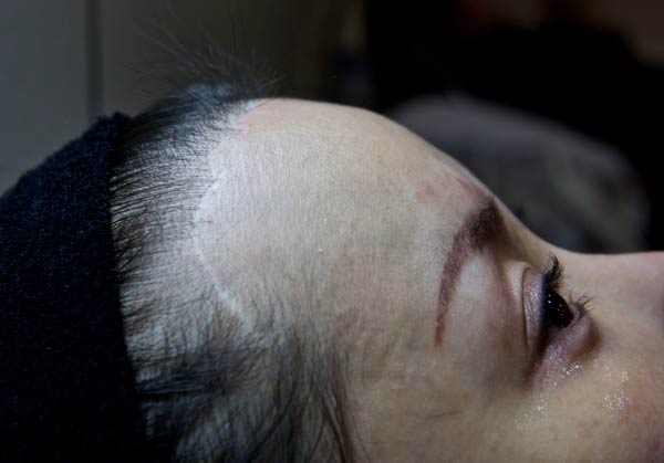 Mi Yuanyuan. a company CEO from Zhejiang province, has a long scar on her forehead and has experienced other side effects after cosmetic surgery in a clinic in South Korea in 2013. (Photo by Feng Zhonghao/For China Daily) Mi Yuanyuan. a company CEO from Zhejiang province, has a long scar on her forehead and has experienced other side effects after cosmetic surgery in a clinic in South Korea in 2013. (Photo by Feng Zhonghao/For China Daily)