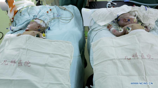 Photo taken on June 9, 2015 shows the successfully separated conjoined twins in east China's Shanghai Municipality. The conjoined twins, who were born on March 17 in east China's Jiangxi Province, were successfully separated Tuesday at the Children's Hospital of Fudan University here in Shanghai. (Photo: Xinhua/Liu Ying) Photo taken on June 9, 2015 shows the successfully separated conjoined twins in east China's Shanghai Municipality. The conjoined twins, who were born on March 17 in east China's Jiangxi Province, were successfully separated Tuesday at the Children's Hospital of Fudan University here in Shanghai. (Photo: Xinhua/Liu Ying)