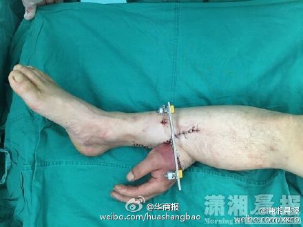 The hand was preserved by being grafted to his leg. (Photo/Weibo) The hand was preserved by being grafted to his leg. (Photo/Weibo)