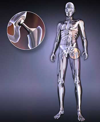 World's first 3D-printed hip joint approved to mass production World's first 3D-printed hip joint approved to mass production