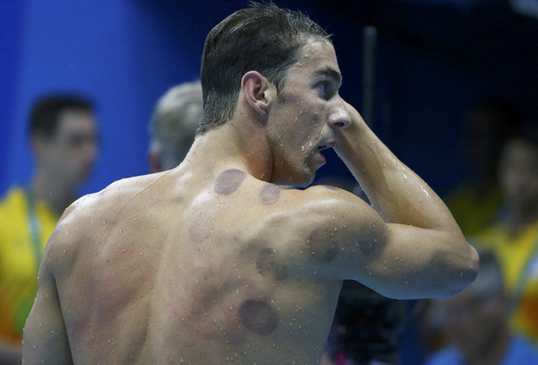 U.S. swimmer Michael Phelps has appeared at the Rio Olympics with purple circles dotting his back and shoulder-the telltale mottling left by the ancient Chinese treatment of cupping. (Photo provided to China Daily) U.S. swimmer Michael Phelps has appeared at the Rio Olympics with purple circles dotting his back and shoulder-the telltale mottling left by the ancient Chinese treatment of cupping. (Photo provided to China Daily)