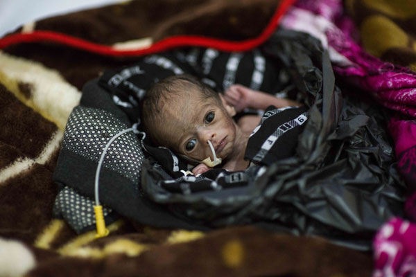 Baby Faadumo, who was born prematurely, is kept warm using a black plastic bag. Photo Provided By UNICEF Baby Faadumo, who was born prematurely, is kept warm using a black plastic bag. Photo Provided By UNICEF