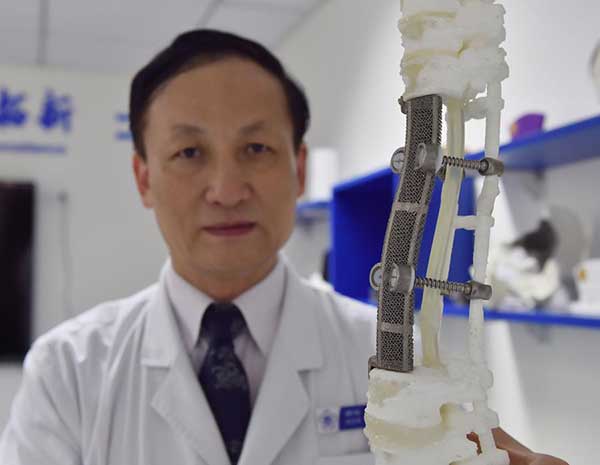 Chinese doctors set a new record in a spinal operation to replace five vertebrae with 3D-printed replicas. The 3D-printed vertebrae measured 19 centimeters, the longest ever in a successful operation.(Photo/Xinhua) Chinese doctors set a new record in a spinal operation to replace five vertebrae with 3D-printed replicas. The 3D-printed vertebrae measured 19 centimeters, the longest ever in a successful operation.(Photo/Xinhua)
