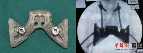 A 3D-printed sacrum is used to help treat sacrum cancer at Peking University People’s Hospital. (Photo/Chinanews.com) A 3D-printed sacrum is used to help treat sacrum cancer at Peking University People’s Hospital. (Photo/Chinanews.com)