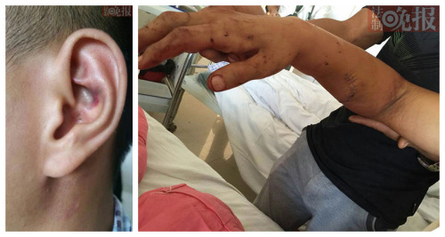Guo shows his hurt arm and ear to reporters. (Photo/Mirror) Guo shows his hurt arm and ear to reporters. (Photo/Mirror)