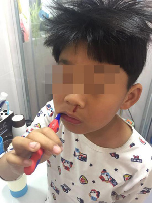 A boy has nosebleed while brushing his teeth. (Photo from Video screenshot) A boy has nosebleed while brushing his teeth. (Photo from Video screenshot)