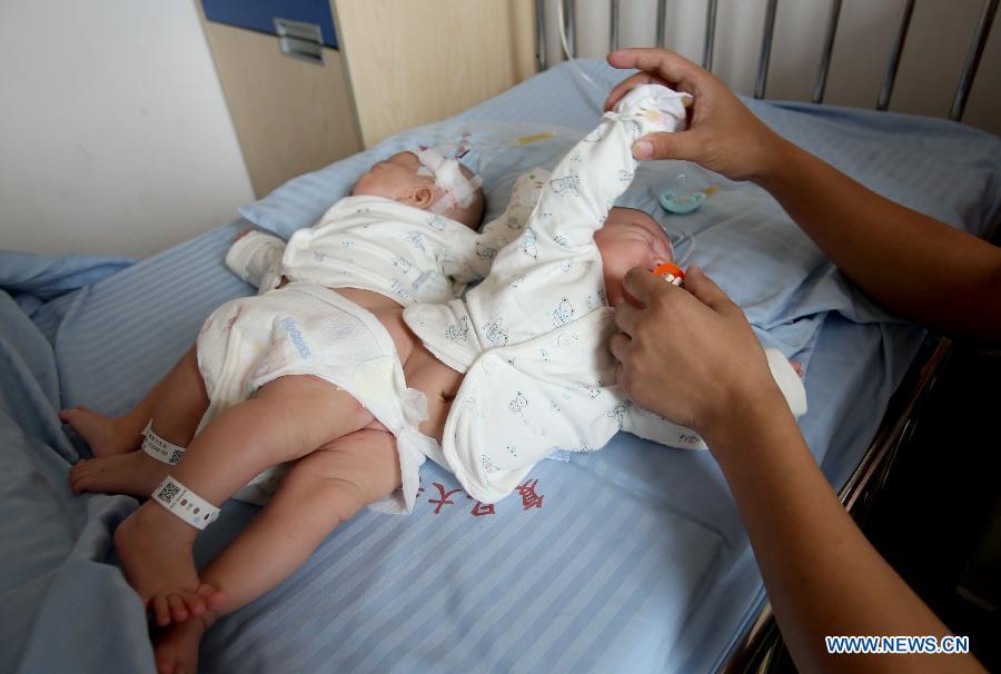 Conjoined twins successfully separated in China(1/3)