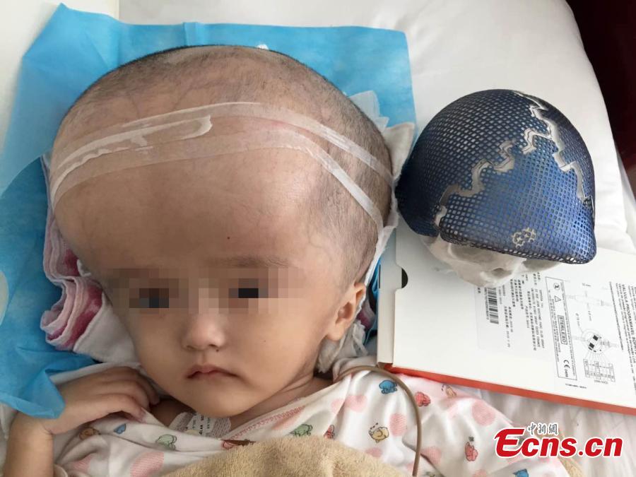 Girl with hydrocephalus cured after surgery (1/4)