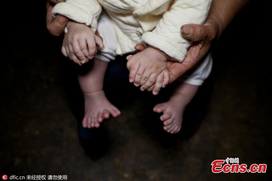 Infant with 31 fingers and toes(1/3)