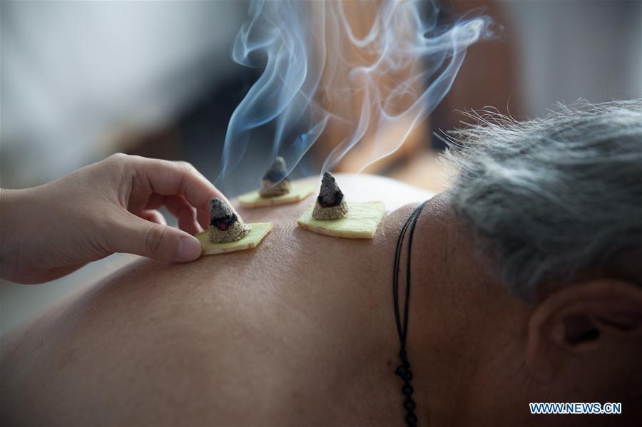 File photo taken on July 12, 2017 shows a patient receiving moxibustion treatment at a traditional Chinese medicine hospital in Gaoqing County, east China\'s Shandong Province. Traditional Chinese medicine (TCM), one of the world\'s oldest forms of medicine with different practices including acupuncture, bee-sting therapy, cupping, moxibustion, scrapping, tui na (Chinese therapeutic massage), still prevails in the modern society after thousands of years of evolution, during which generations have restored and maintained health depending on it. The World Health Organization disease index was updated to include references to traditional Chinese medicine for the first time in June 2018. (Xinhua/Zhang Weitang)
