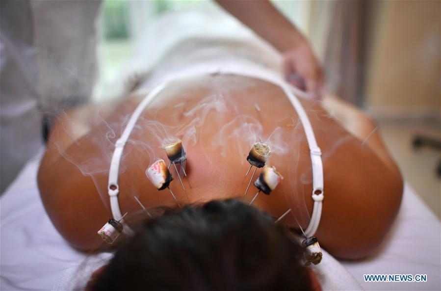 File photo taken June 2, 2018 shows a Russian tourist experiencing moxibustion treatment at Sanya International Friendly Chinese Medicine Sanatorium in Sanya, south China\'s Hainan Province. Traditional Chinese medicine (TCM), one of the world\'s oldest forms of medicine with different practices including acupuncture, bee-sting therapy, cupping, moxibustion, scrapping, tui na (Chinese therapeutic massage), still prevails in the modern society after thousands of years of evolution, during which generations have restored and maintained health depending on it. The World Health Organization disease index was updated to include references to traditional Chinese medicine for the first time in June 2018. (Xinhua/Guo Cheng)