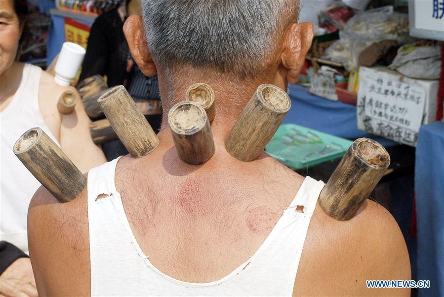 File photo taken on May 24, 2003 shows a man experiencing cupping by roadside in Guiyang, capital of southwest China\'s Guizhou Province. Traditional Chinese medicine (TCM), one of the world\'s oldest forms of medicine with different practices including acupuncture, bee-sting therapy, cupping, moxibustion, scrapping, tui na (Chinese therapeutic massage), still prevails in the modern society after thousands of years of evolution, during which generations have restored and maintained health depending on it. The World Health Organization disease index was updated to include references to traditional Chinese medicine for the first time in June 2018. (Photo/Xinhua)