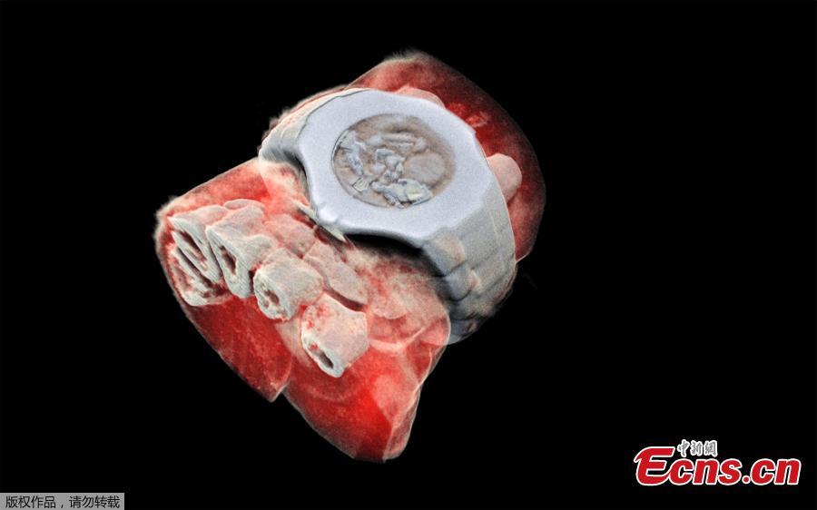 This picture released on July 12, 2018 by MARS Bioimaging Ltd shows a 3D image of a wrist with a watch showing part of the finger bones in white and soft tissue in red. New Zealand scientists has done the first-ever 3-D, colour X-ray on a human, using a technique promising to improve the field of medical diagnostics, announced Europe\'s CERN physics lab which contributed technology. (Photo/Agencies)