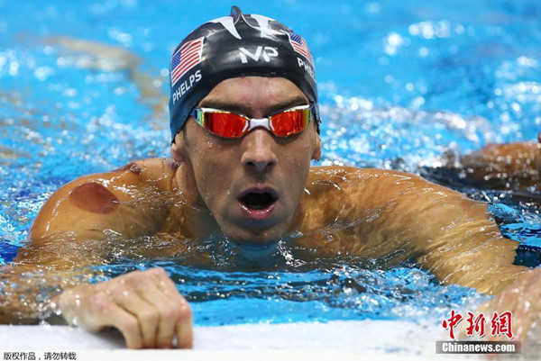 Round brown marks left by the traditional Chinese cupping treatment are seen on the body of American Olympic champion Michael Phelps.(Photo/Agencies) Round brown marks left by the traditional Chinese cupping treatment are seen on the body of American Olympic champion Michael Phelps.(Photo/Agencies)